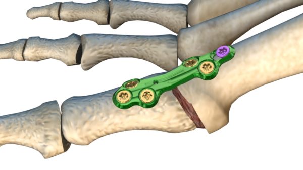 Stepping Toward the Right Medical Stock – Wright Medical Group